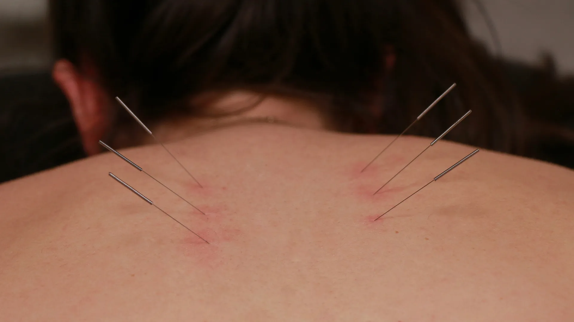 Acupuncture Image 3