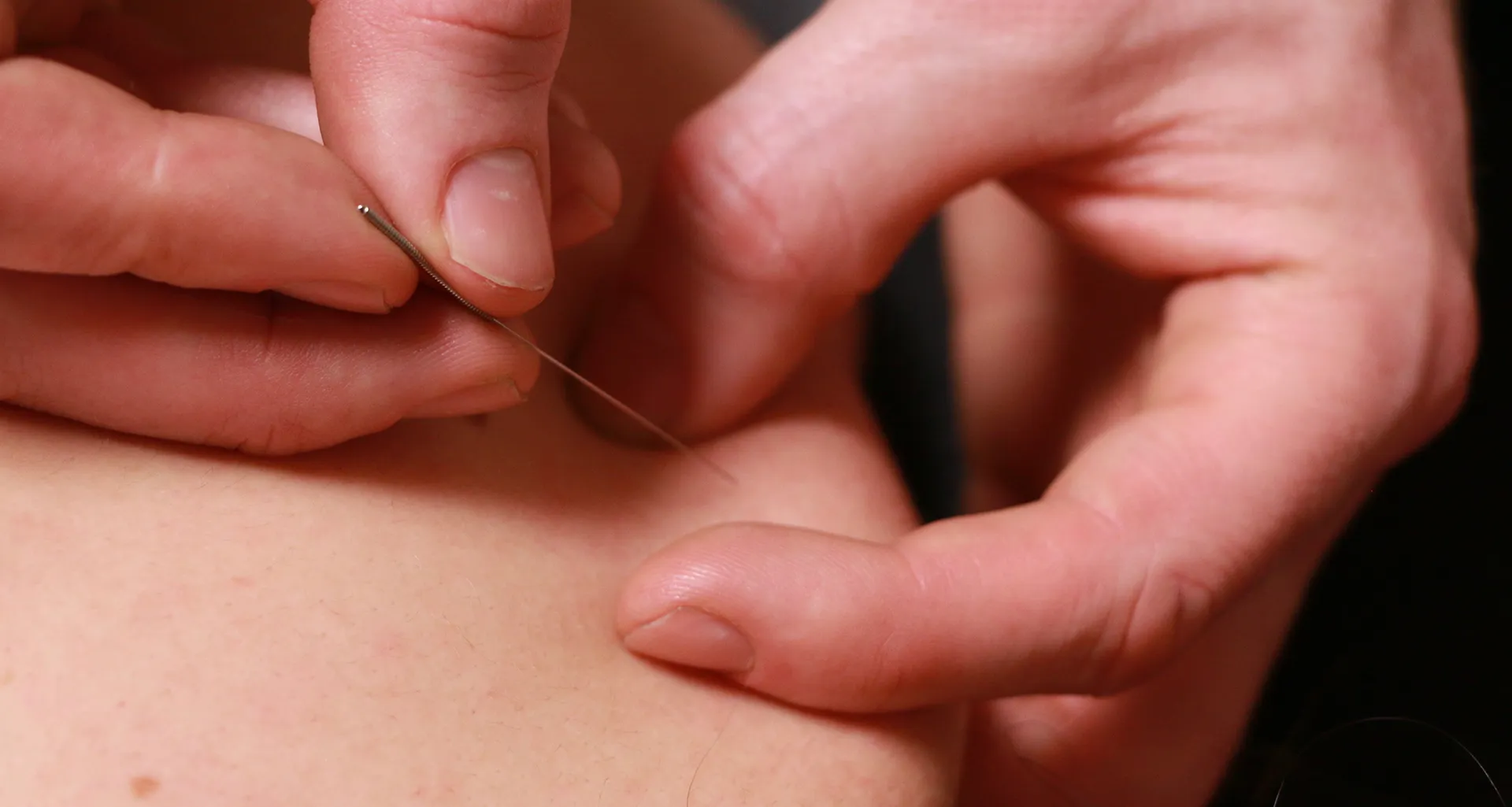 Dry Needling Image 2 1